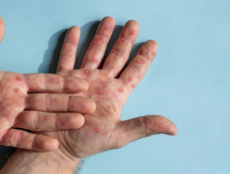 majomhimlő járvány mpox WHO