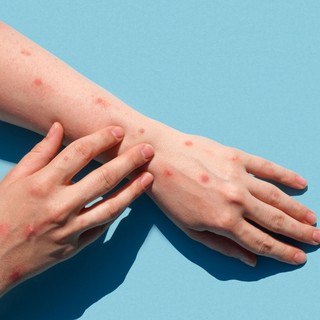 Alaszkai himlő: a tünetek elsőre könnyen összetéveszthetők egy pókcsípéssel című cikk nyitóképe