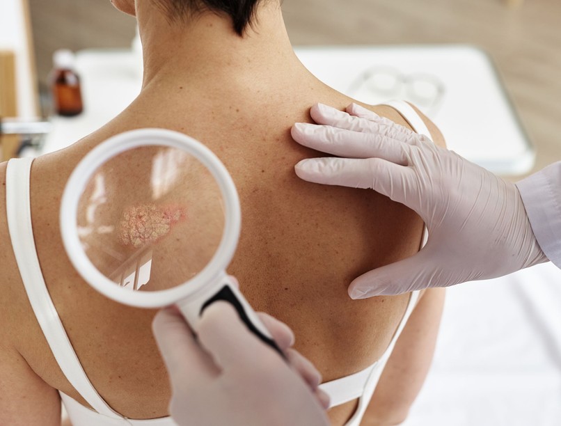 Áttörés a pikkelysömör kezelésében