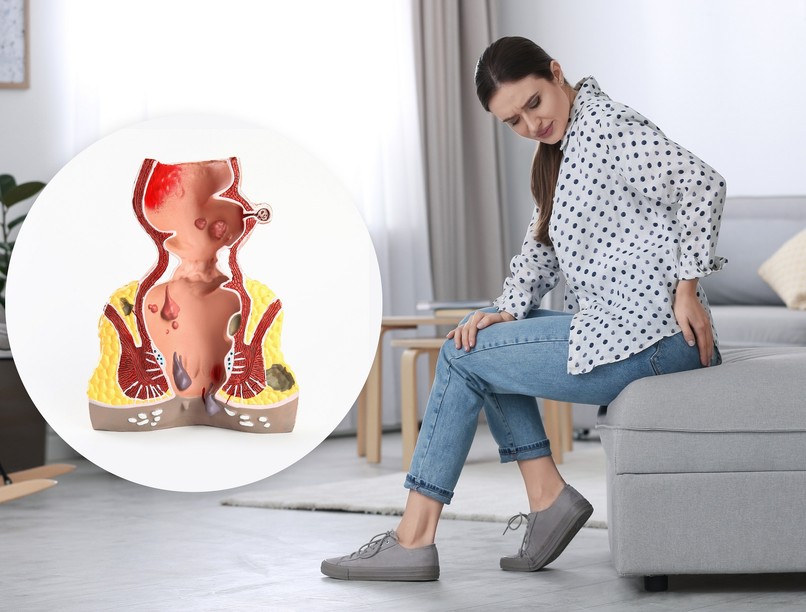 negyedik stádium előrehaladott aranyér tünete