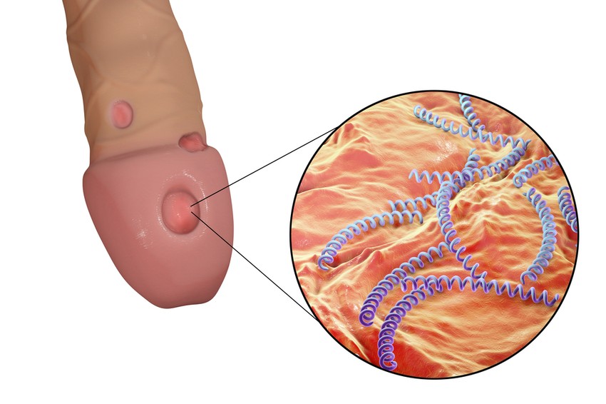 A Treponema pallidum baktérium által okozott fertőzés. Az első stádiumban a betegség a vaginális/anális/orális szexuális kapcsolatok révén terjed a baktériumokkal telt fekélyek útján. 