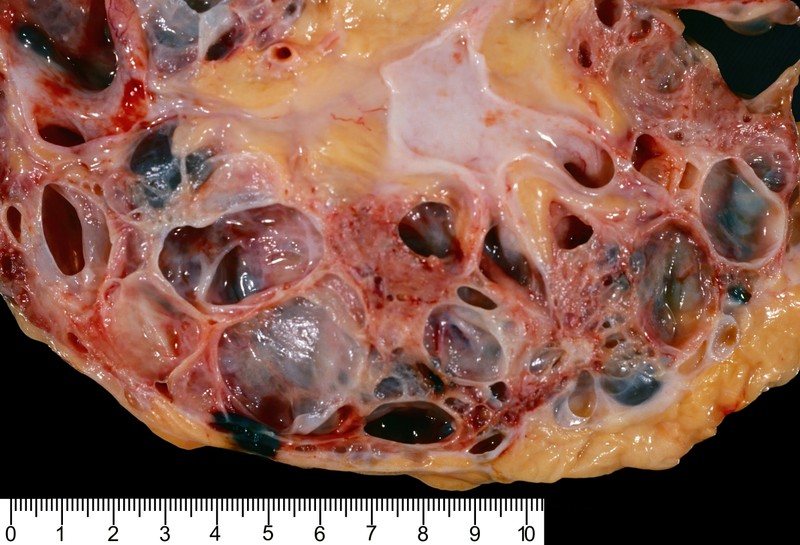 Policisztás vesebetegség tünetei, vizsgálata és kezelése