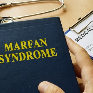 Marfan-szindróma tünetei, vizsgálata és kezelése című cikk nyitóképe