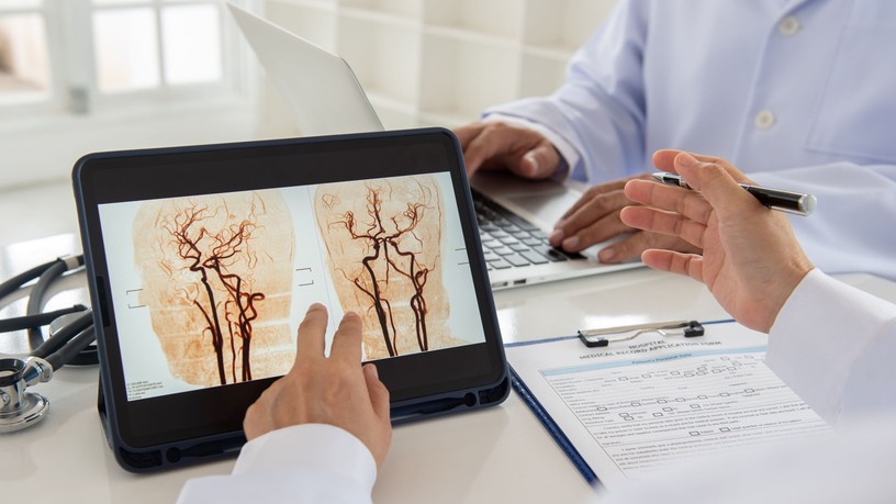 agyi infarktus agyvérzés stroke sztrók tünetei