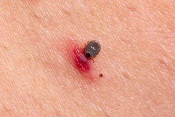 Piros a kullancscsípés helye? Nem mindig Lyme-kór – de vegye komolyan!