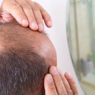 Egy hajszálnyira a siker: a tudósok végre megtalálták a kopaszság lehetséges ellenszerét című cikk nyitóképe