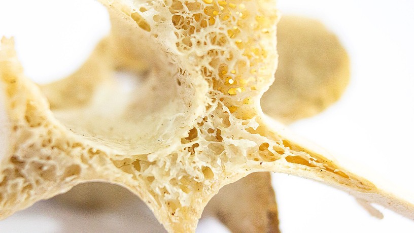 osteoporosis csontritkulás kezelés nélkül