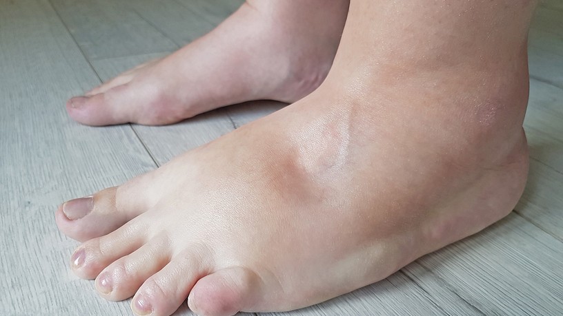 ödéma a végtagokon oka szívbetegség