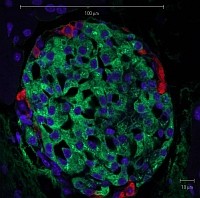 Nagy előrelépés az 1-es típusú diabétesz őssejtes kezelésében