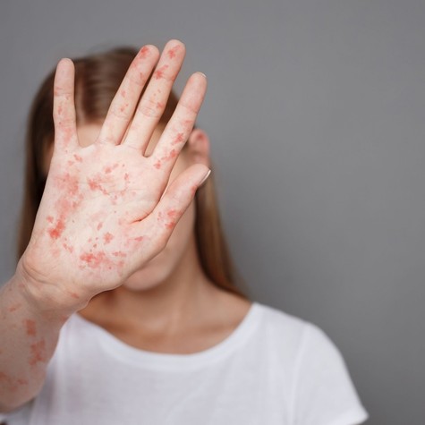 Hiába a vakcina, mégis terjed: miért nem tűnik el a kanyaró Európából? című cikk nyitóképe