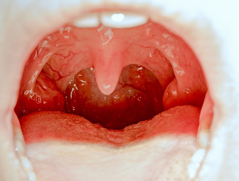 Fehér foltok mandulakő rossz lehelet