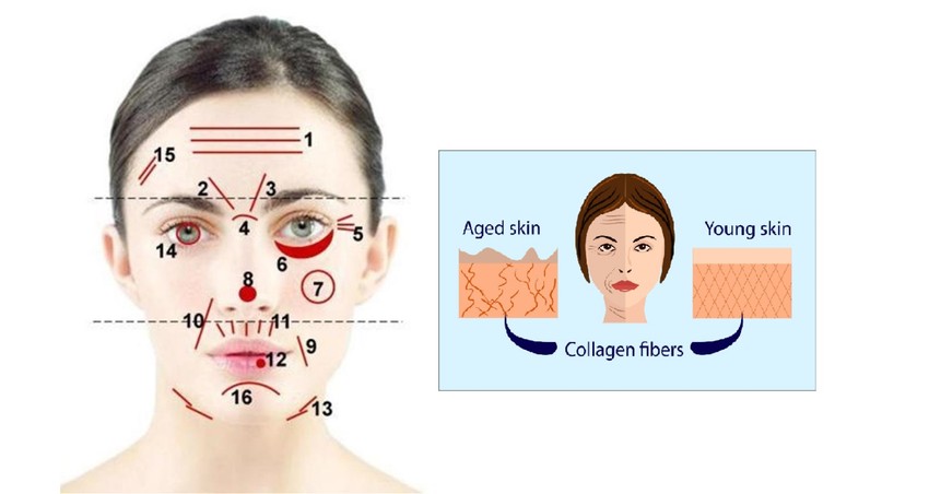 A kollagén a bőrben egy rugalmas tartószerkezetet képez, ha ennek a mennyisége csökken, az a ráncok kialakulásához vezet.