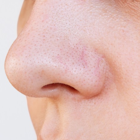 Fekete pöttyök az orron: így tüntetheti el a mitesszereket című cikk nyitóképe