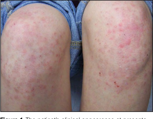 A Gianotti-Crosti szindrómát több vírus is okozhatja (EBV, CMV, Coxackie), de leírták védőoltások (Di-Per-Te, Mumpsz-Morbilli-Rubeola) beadása után is. 