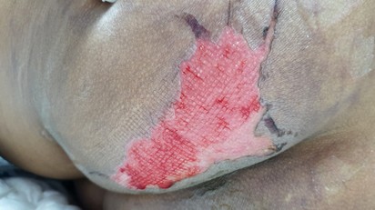 Felfekvés (decubitus): megelőzés, tünetek, kezelés és a legújabb terápiás lehetőségek című cikk nyitóképe