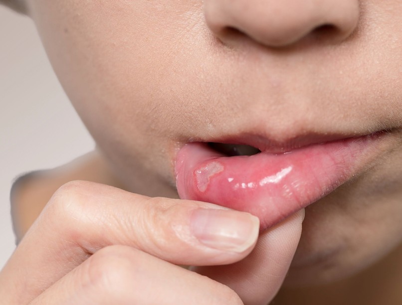 vitaminhiány B12 hiány tünet száj nyelv