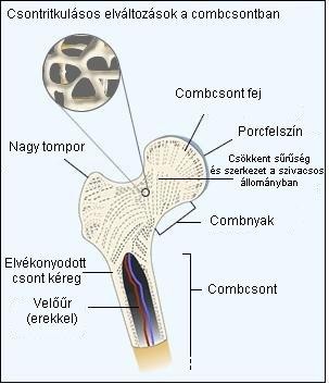 Csontritkulás (oszteoporózis)