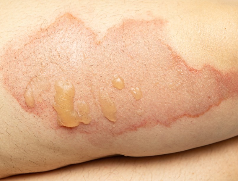 bőrbetegség leégés napégés scanner Google