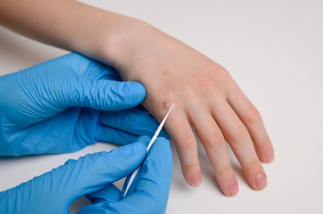 Hogyan szabadulhatunk meg a szemölcsöktől? Ezek a leghatékonyabb módszerek rá