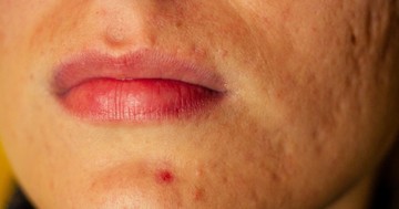  Mit jelez a szervezet az állon megjelenő pattanással? Nem mindig csak bőrprobléma 