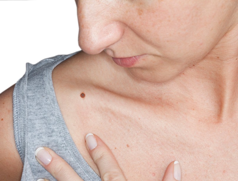 anyajegy, melanoma, daganat, rák