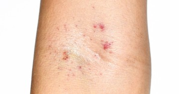 Leukémia - ilyen külső tünetek jelezhetik