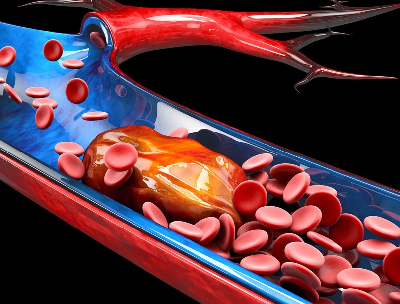 stroke agyvérzés magas vérnyomás ellen