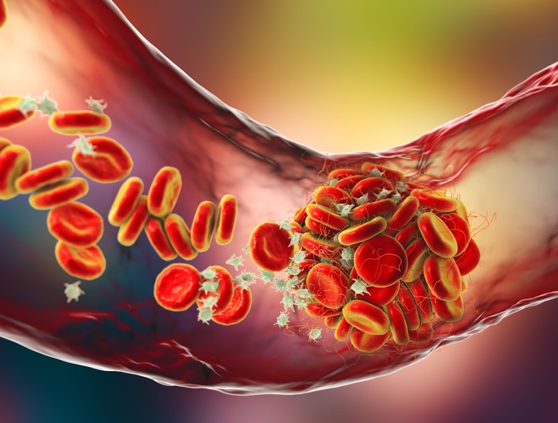 véralvadásgátló szedése mellett trombózis