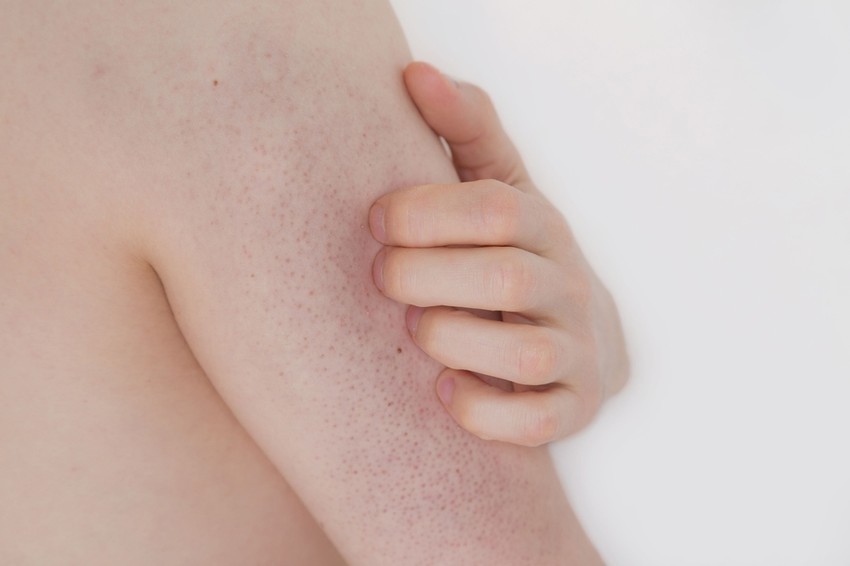 A keratosis pilaris többnyire pirosas vagy fehéres, keménykés dudorokként jelenik meg, de előfordul, hogy a dudorok helyett csupán makacs piros foltot észlelünk a bőrön. Az elváltozás mindig szimmetrikus, vagyis ha az egyik felkaron megjelenik, akkor a másikon is.