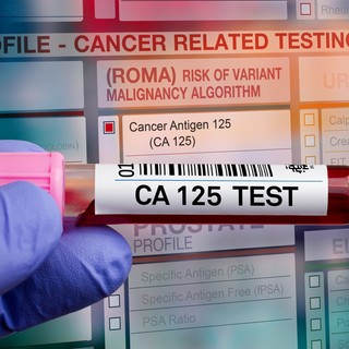 Mit jelent a CA-125 érték a laborleleten? című cikk nyitóképe