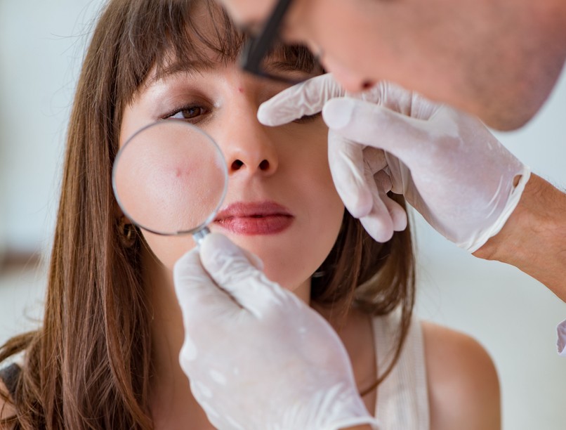 bőr akné pattanás dohányzás cigaretta