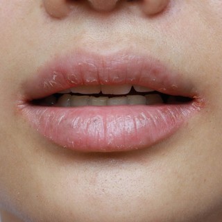 Szájzug-gyulladás: tünetei, vizsgálata és kezelési lehetőségei című cikk nyitóképe