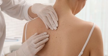 Ezért fontos időben eltávolítani a basaliomát - a sebész tanácsai