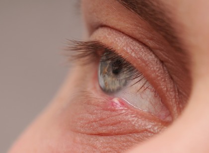 Mitől nőhet árpa a szemre, és hogyan szabadulhatunk meg tőle? című cikk nyitóképe