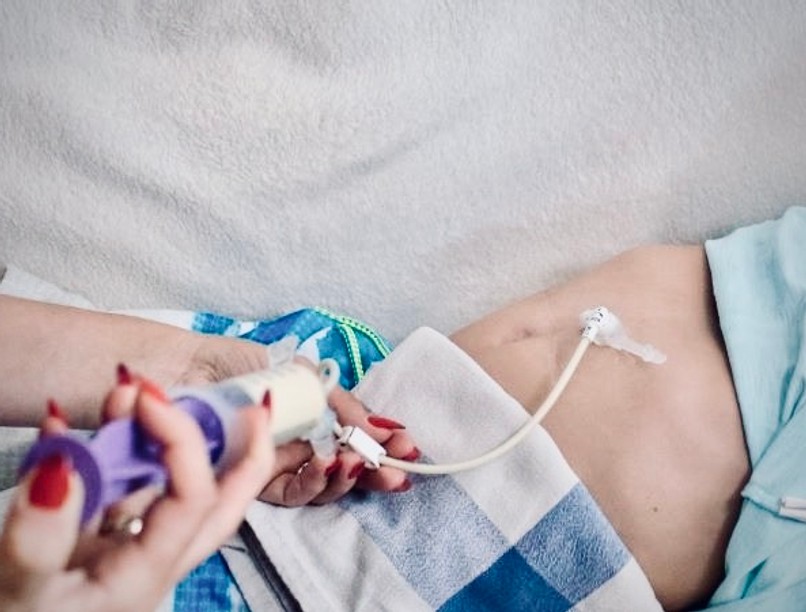 szondatáplálás, táplálásterápia, szondatápszer, otthonápolás