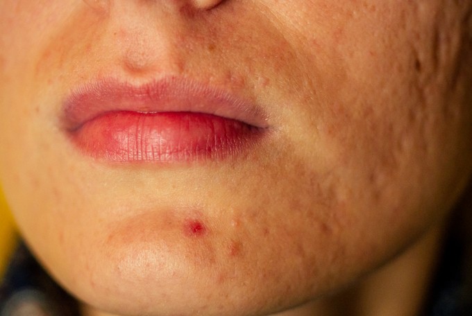 Mit jelez a szervezet az állon megjelenő pattanással? Nem mindig csak bőrprobléma című cikk nyitóképe