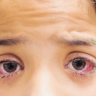 Nem múló kötőhártya gyulladás: mi számít annak, és mit lehet ilyenkor tenni? című cikk nyitóképe