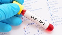 Enyhén emelkedett a CEA tumormarkerem - érdemes aggódni? Az orvos válaszol   című cikk nyitóképe