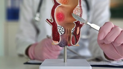 Divertikulum (béltágulat): tüntei, vizsgálata és kezelési lehetőségei című cikk nyitóképe