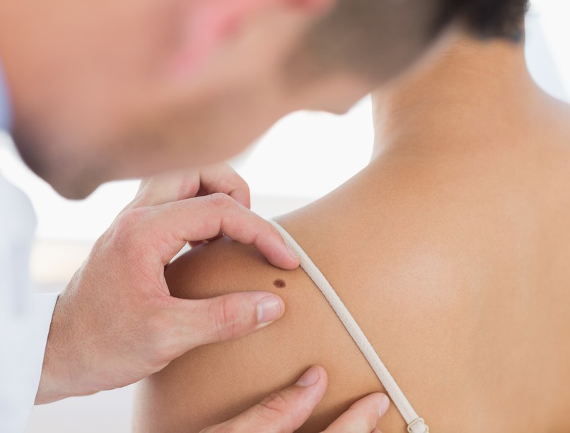 melanóma, bőrrák, daganat, anyajegy, műtét