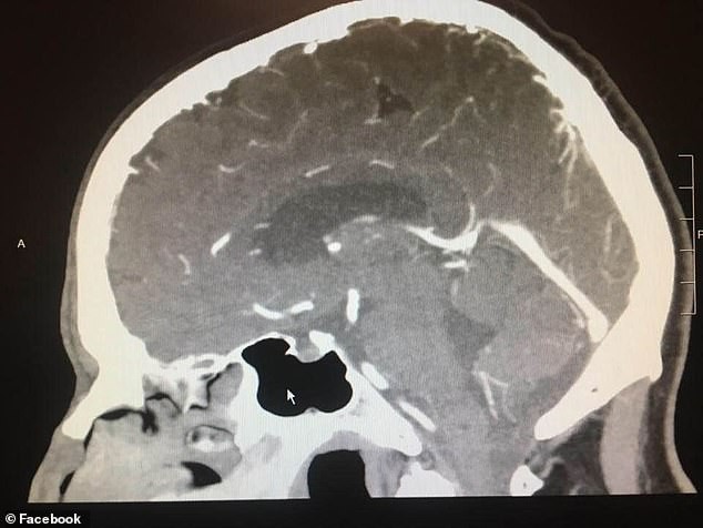 Nem sokkal később a daganat teljesen eltűnt.