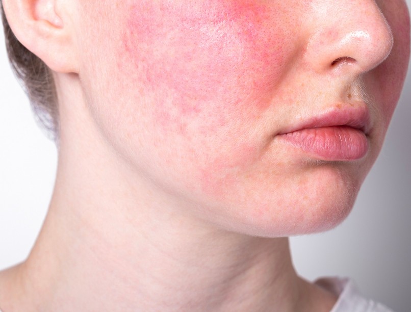 lepkehimlő Mennyi idő alatt gyógyul