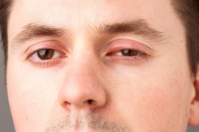 Mire utal a szemhéjduzzanat?