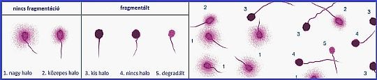 Új lehetőség a férfi meddőség genetikai okának kimutatására!