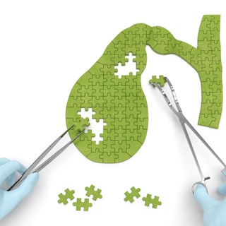 Epekövesség után valóban indokolt az epehólyag eltávolítása? Van kockázata? Az orvos válaszol című cikk nyitóképe