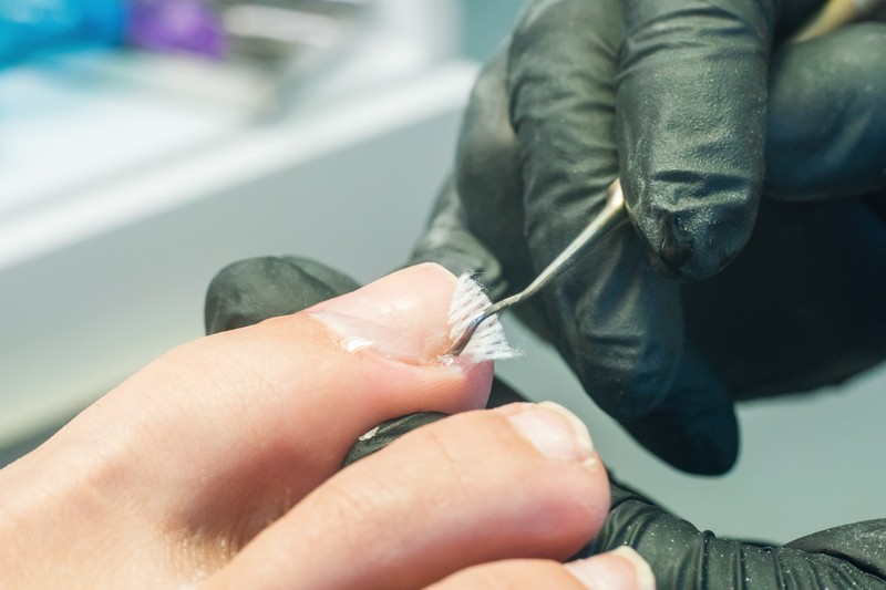 Benőtt köröm okozta fájdalmak: nemcsak a szűk cipő lehet a hibás!