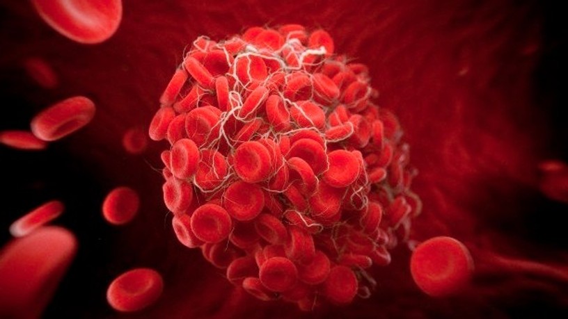 venous-thromboembolism_0