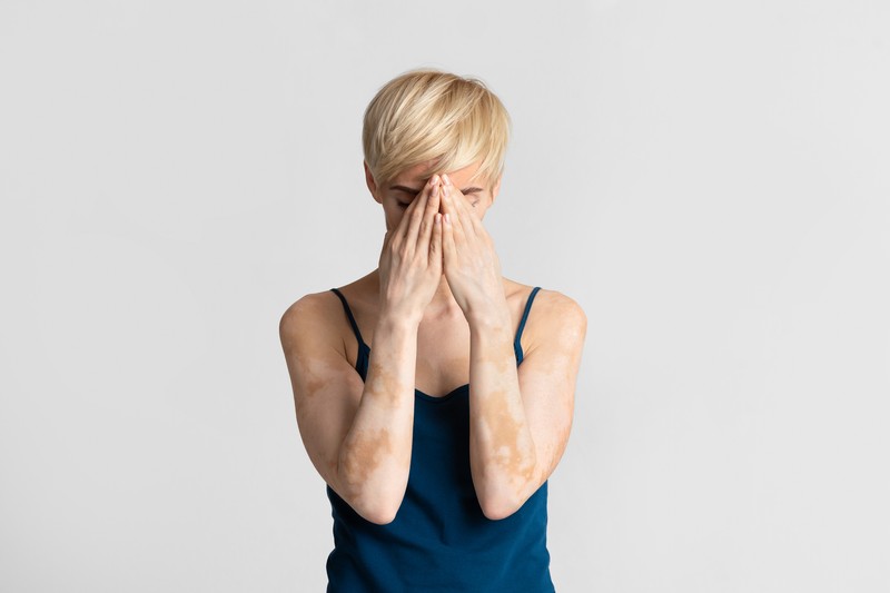 Csak a napsugárzás okozhat hiperpigmentációt? Így tüntethetjük el a barna foltokat