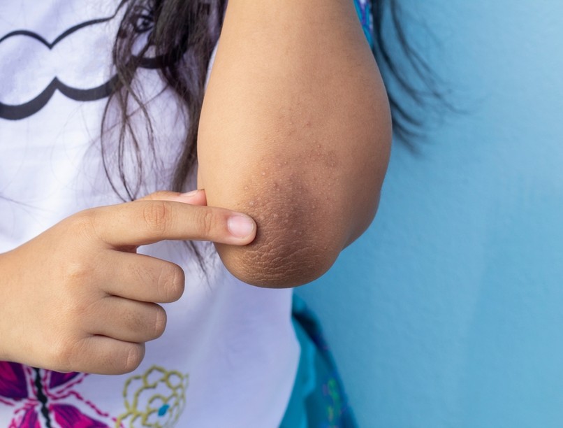 Scleroderma autoimmun betegség