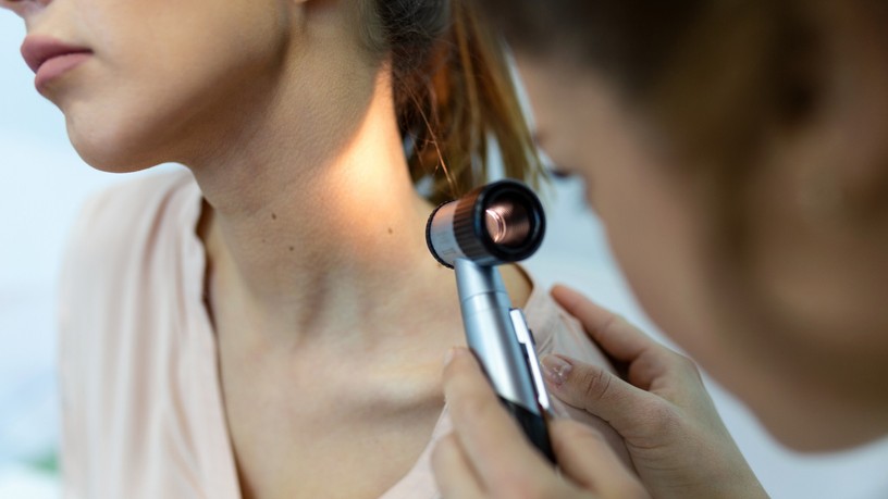 anyajegyszures, melanoma, daganat